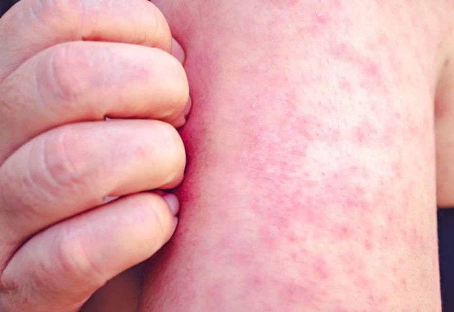 Sarampión avanza en México